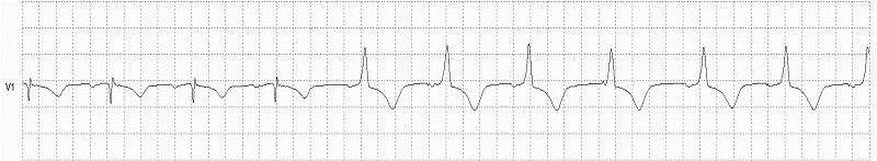 Ventricular Paced Beat RBB Morphology